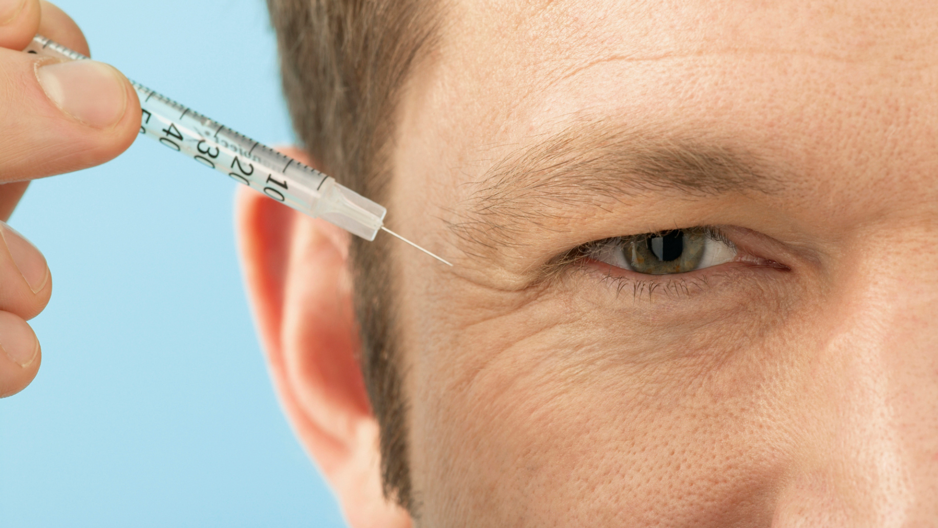 botox around the eyes (crow's feet)