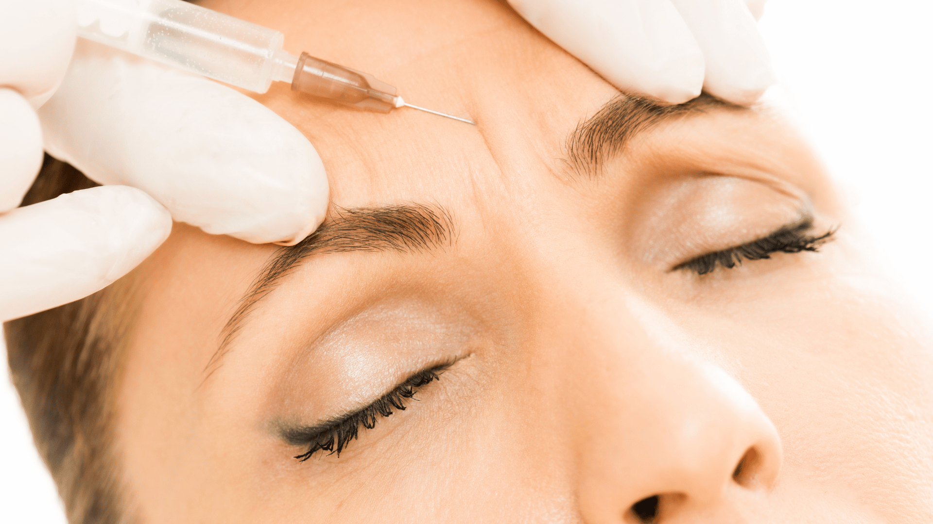 botox forehead lines